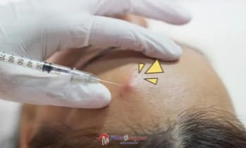 Betulkah Suntik Jerawat Mengakibatkan Bopeng? Oleh: dr. Yulia W.P., M. Biomed, M. H. Kes., AIFO-K